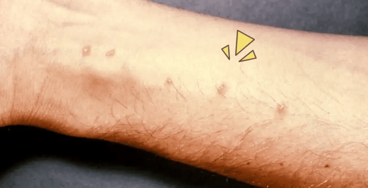 Waspadai Skistosomiasis