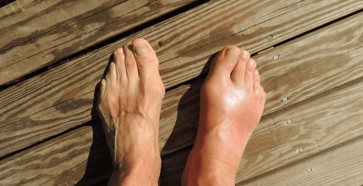 5 kebiasaan pagi efektif kendalikan asam urat